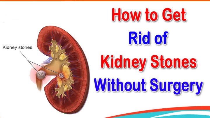 8 Kidney Stone Treatment Without Surgery